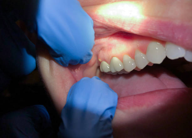 Best Emergency Root Canal Treatment in Williamsport, OH